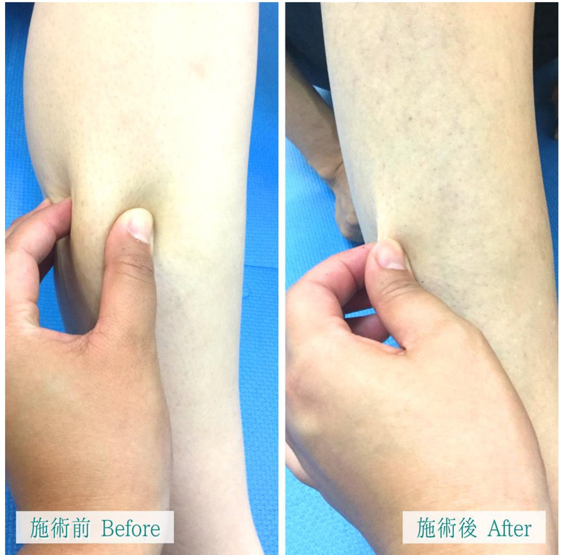 Fascia-Release-therapy